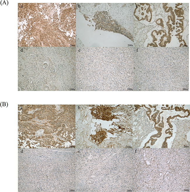 Immunohistochemical staining of CLIC1 and LGALS3BP in ovarian cancer and normal ovary tissues.
