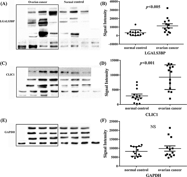 Western blot analysis of LGALS3BP and CLIC1 in all tissue samples of ovarian cancer and normal control.