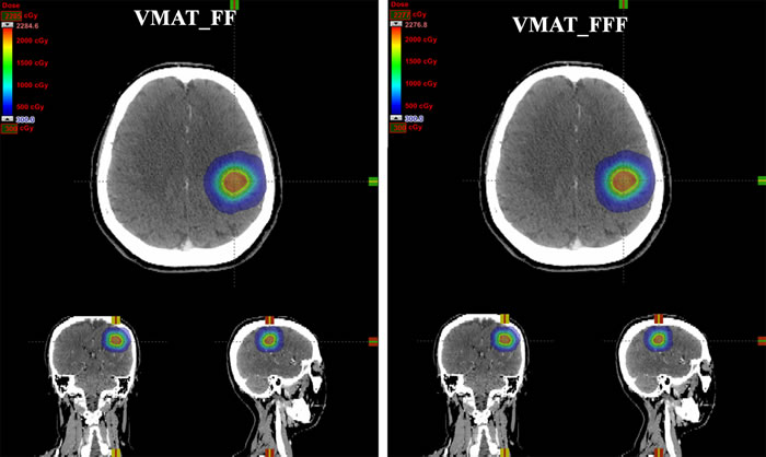 Dose distributions for one patient with single brain metastasis in axial, coronal, and sagittal planes using two different treatment planning techniques: VMAT_FF = VMAT plans with conventional flattened (FF) beams; VMAT_FFF = VMAT plans with flattening filter free (FFF) beams.