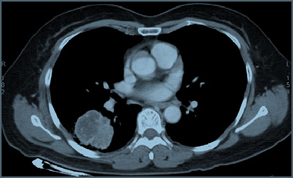 CT scan showing the mass in the right lower lung.