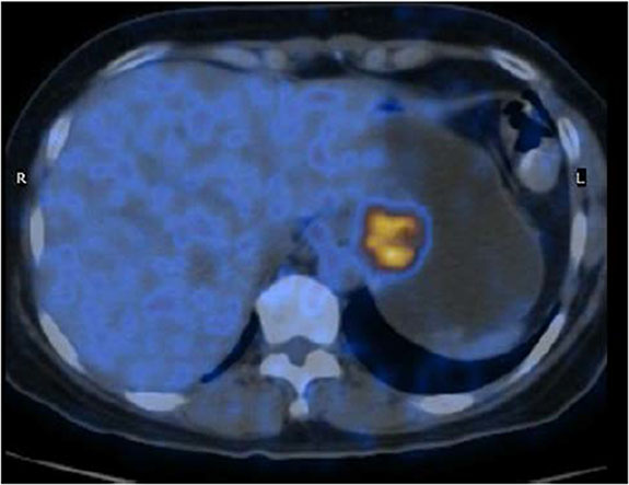 PET/CT scan showing the gastric lesion in the cardia.