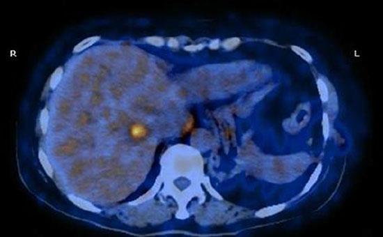 PET/CT scan showing multiple malignant lesions in the liver and suggesting liver metastases.