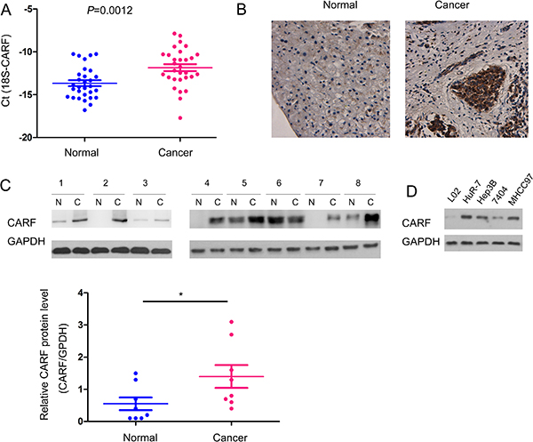 The expression of CARF was up-regulated in human HCC samples.