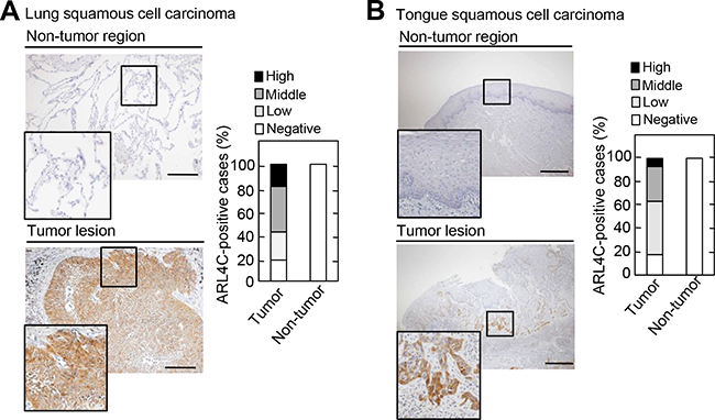 ARL4C is expressed in human lung and tongue squamous cell carcinomas.