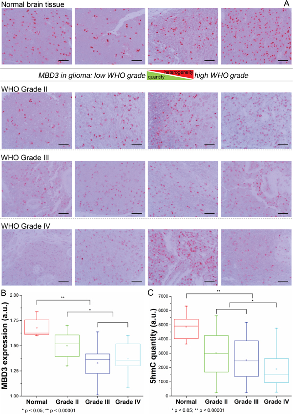 Expression pattern of MBD3 protein in normal brain tissue and malignant glioma.