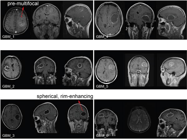 Brain MRI images of GBM patients enrolled in the clinical cohort.