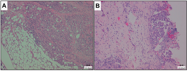 Histological imagines of representative epithelioid malignant pleural mesothelioma (MPM) and mesothelial hyperplasia (MH).