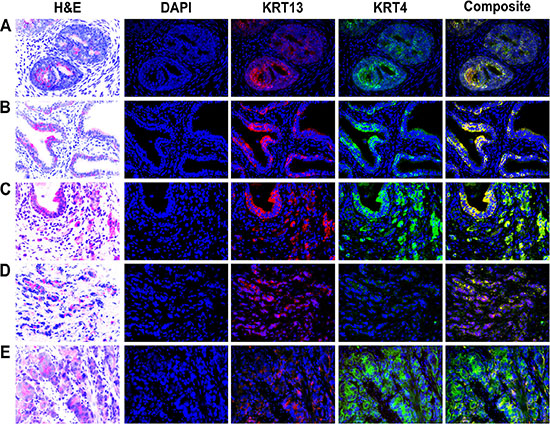 Expression of KRT13 and KRT4 in developmental, benign, and malignant prostate glands.