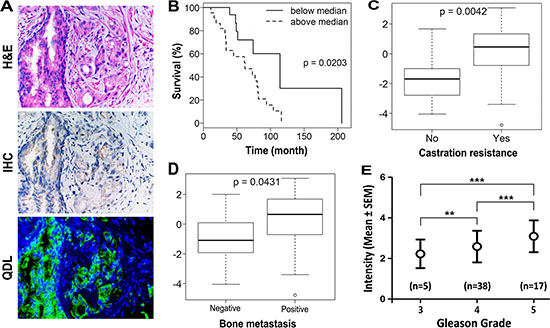 KRT13 expression in prostate cancer correlates with the progression and overall survival of prostate cancer patients.