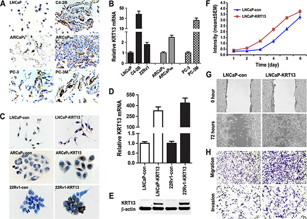 KRT13 expression correlates with cancer progression in three metastatic prostate cancer cell models.