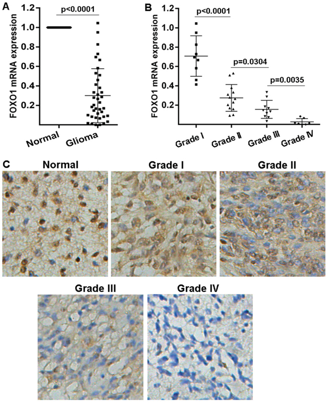 FOXO1 expression pattern in glioma.