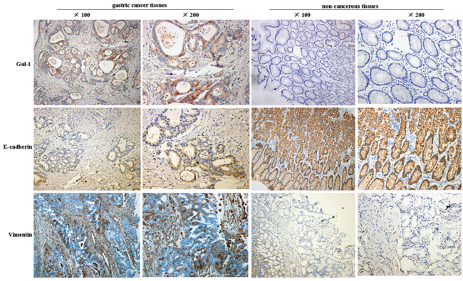Representative images of immunohistochemical staining for Gal-1, E-cadherin and vimentin in human gastric cancer tissues and non-cancerous tissues.