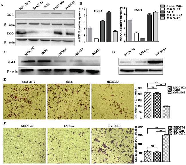 Gal-1 promotes the invasion of human gastric cancer cells.