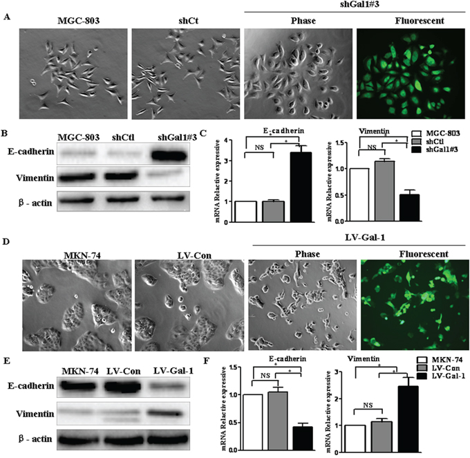 Gal-1 regulates the transition between epithelial and mesenchymal phenotypes in human gastric cancer cells.