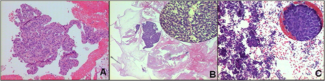 FFPE cytological specimens stained with hematoxylin-eosin for the final diagnosis.