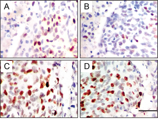 Immunohistochemical expression levels and localization of JMJD1A and c-Myc in cervical cancer tissues.