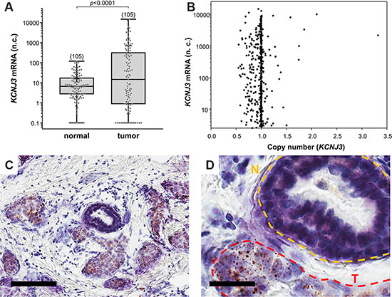 KCNJ3 mRNA levels are higher in tumor than in surrounding normal tissue.