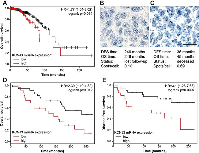 Estrogen receptor positive patients with high KCNJ3 mRNA levels in their tumor have a worse overall and disease free survival probability.