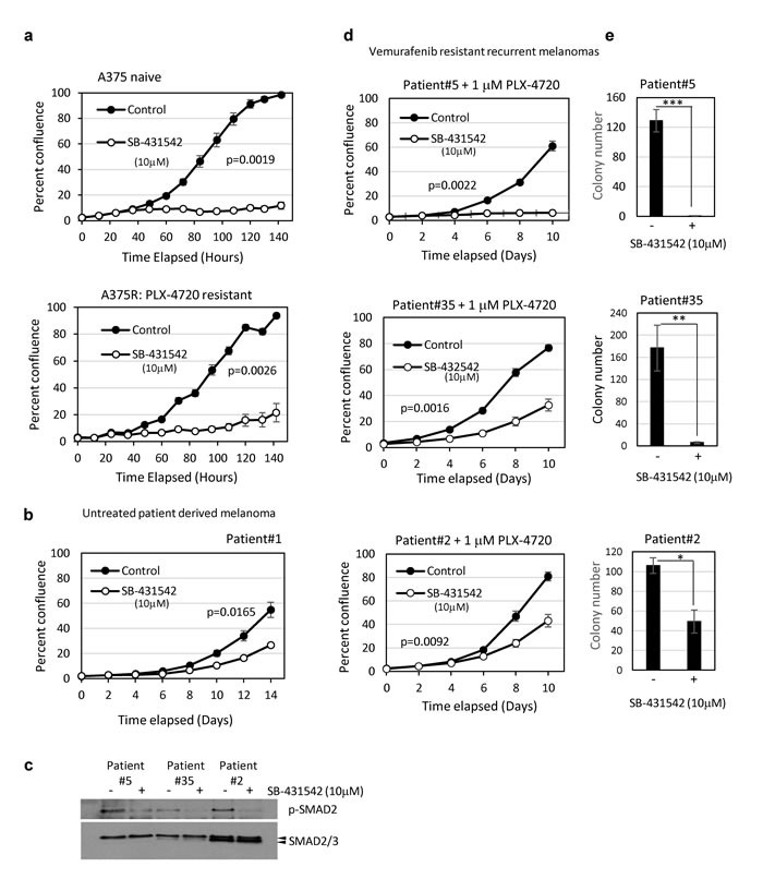 Patient-derived BRAF inhibitor resistant tumour cells are sensitive to TGFBR1 inhibition.