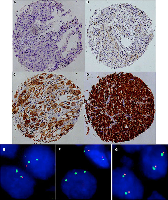 Representative images of p16 immunostaining with (A) negative, (B) weak, (C) moderate, and (D) strong staining and examples of FISH findings using the 9p21 deletion probe.