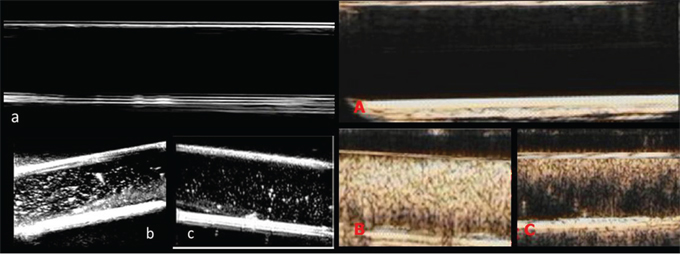 Two-dimensional ultrasonic imaging and ultrasound contrast enhanced imaging of UCAs in vitro.