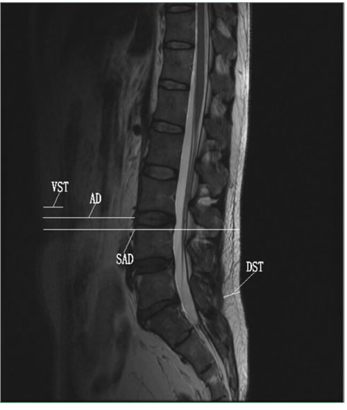 T2-weighted midsagittal plane images of the lumbar spine showing the adiposity diameters measured.