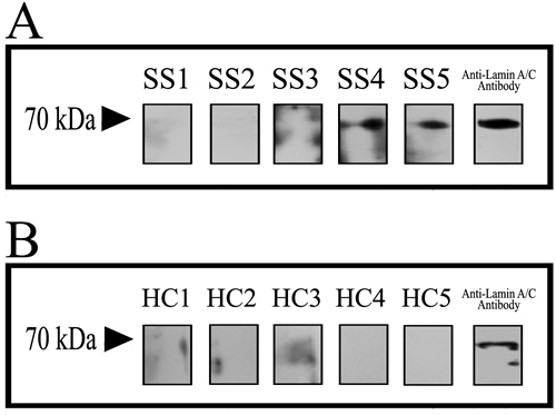 Discover that Lamin A/C is a potential autoantigen of SS.