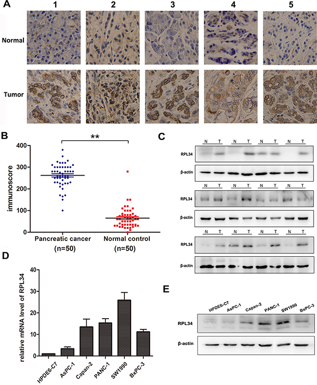 RPL34 is overexpressed in pancreatic cancer tissues and cell lines.