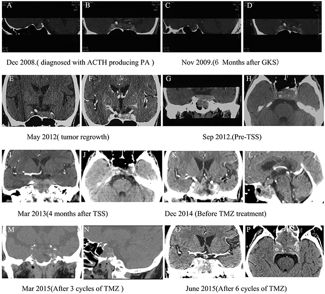 Computed Tomographic (CT) images of pituitary tumors in the case two patient.