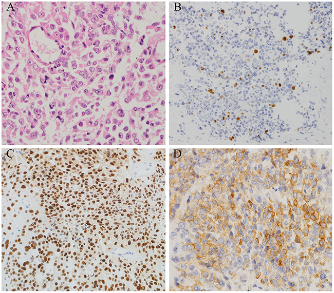 Histopathological findings in resected pituitary tumors from the case two patient.