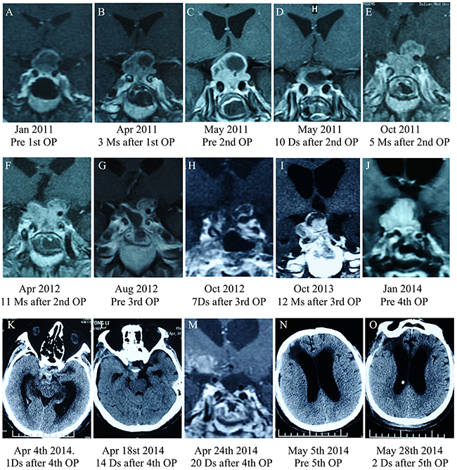 Pituitary MRI images for the case three patient.