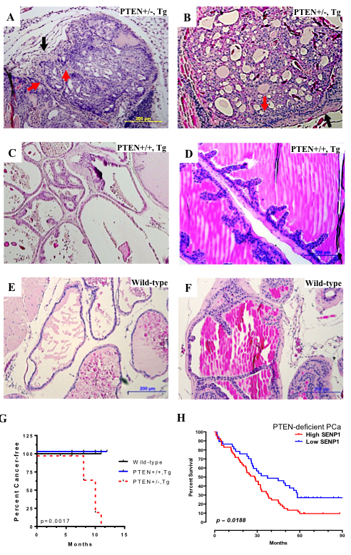 PTEN reduction induces carcinogenesis in SENP1 Transgenic mice