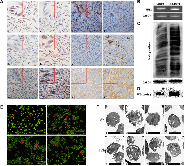 The effects of Lewis y antigen on CD147 regulated autophagy of ovarian cancer cells.