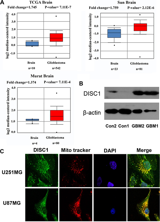 DISC1 expression in human glioblastoma.