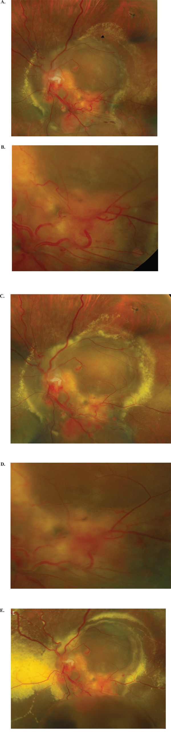 Images of retinal capillary hemangioblastomas (RCH) in the left eye of a 31-year-old patient.