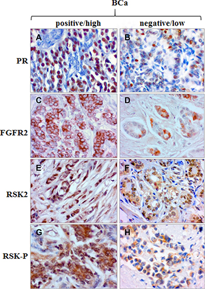Expression of PR, FGFR2, RSK2 and RSK-P in BCa tissue samples.