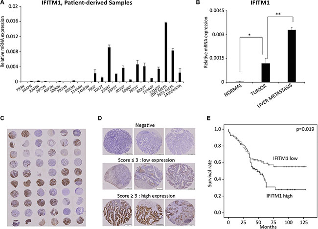 IFITM1 expression is associated with poor prognosis of colorectal cancer patients.