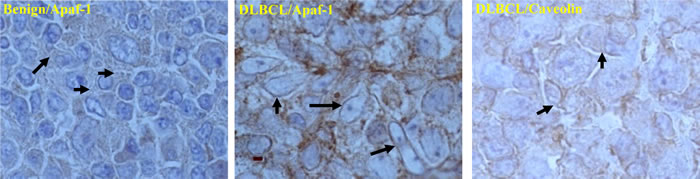 Co-localization of Apaf-1 and caveolin (lipid raft marker) in B-cell Lymphoma.