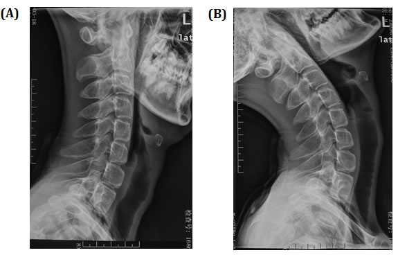 X-ray of cervical flexion and extension