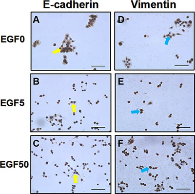 EGF induces a typical EMT cell phenotype changes in Ishikawa cells.