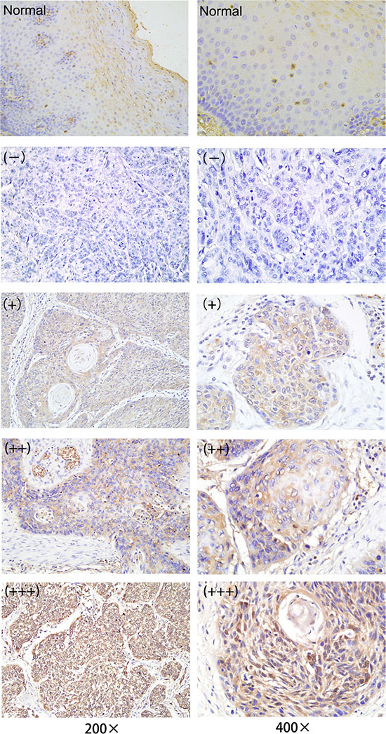 IDH1 expression in patients with ESCC was examined by performing immunohistochemistry.