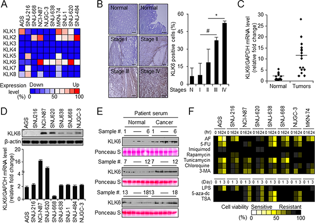 KLK6 expression is upregulated in vivo and in vitro in late-stage gastric cancer.