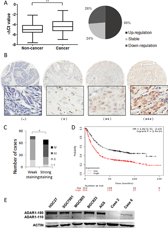 Expression pattern of ADAR1 in gastric cancer tissues and cell lines.