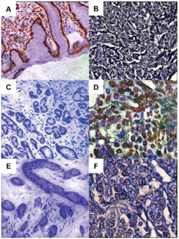 YWHAE, CDC25B and MYC immunoreactivity in gastric tissue samples.