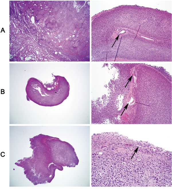 Tumor vascular invasion is suppressed by knockdown of WIPF1 or BRAF in BRAF V600E-bearing thyroid cancer cell-derived tumors.