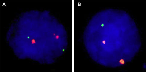 Examples of FISH findings using the 18q deletion probe.