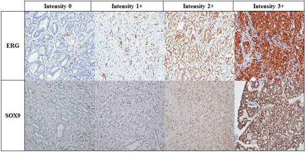 Representative images of ERG and SOX9 detection by IHC in mCRPC patients according to intensity (Magnification x 200).