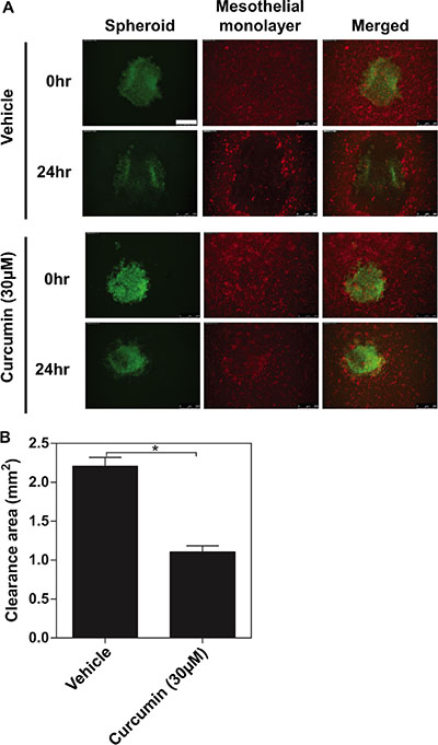 The inhibitory effects of curcumin on ovarian cancer spheroids invading the mesothelial monolayer.