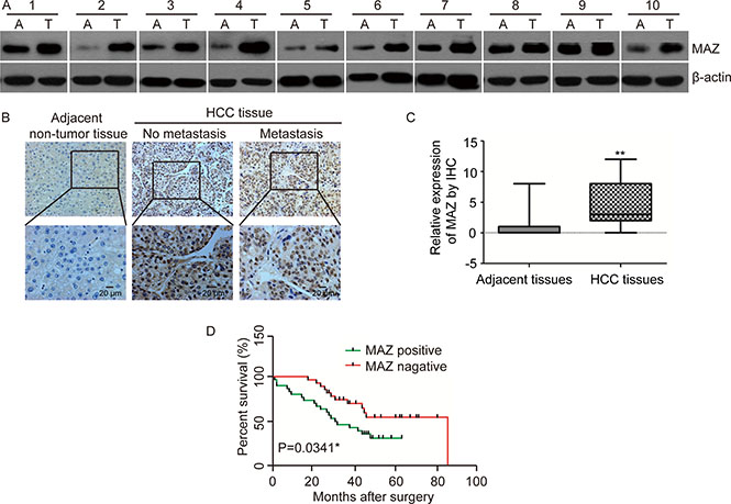 MAZ is highly expressed in HCC and correlated with prognosis of HCC patients.