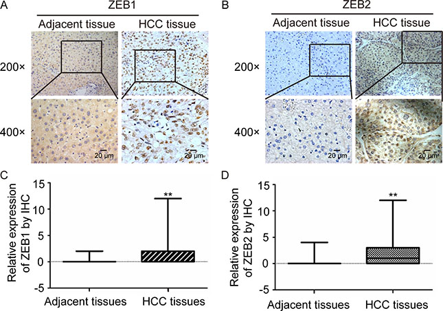 ZEB1 and ZEB2 are over-expressed in HCC tissues.